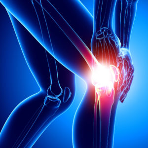 Sindrome Femore-Rotulea- quel dolore al ginocchio da non sottovalutare